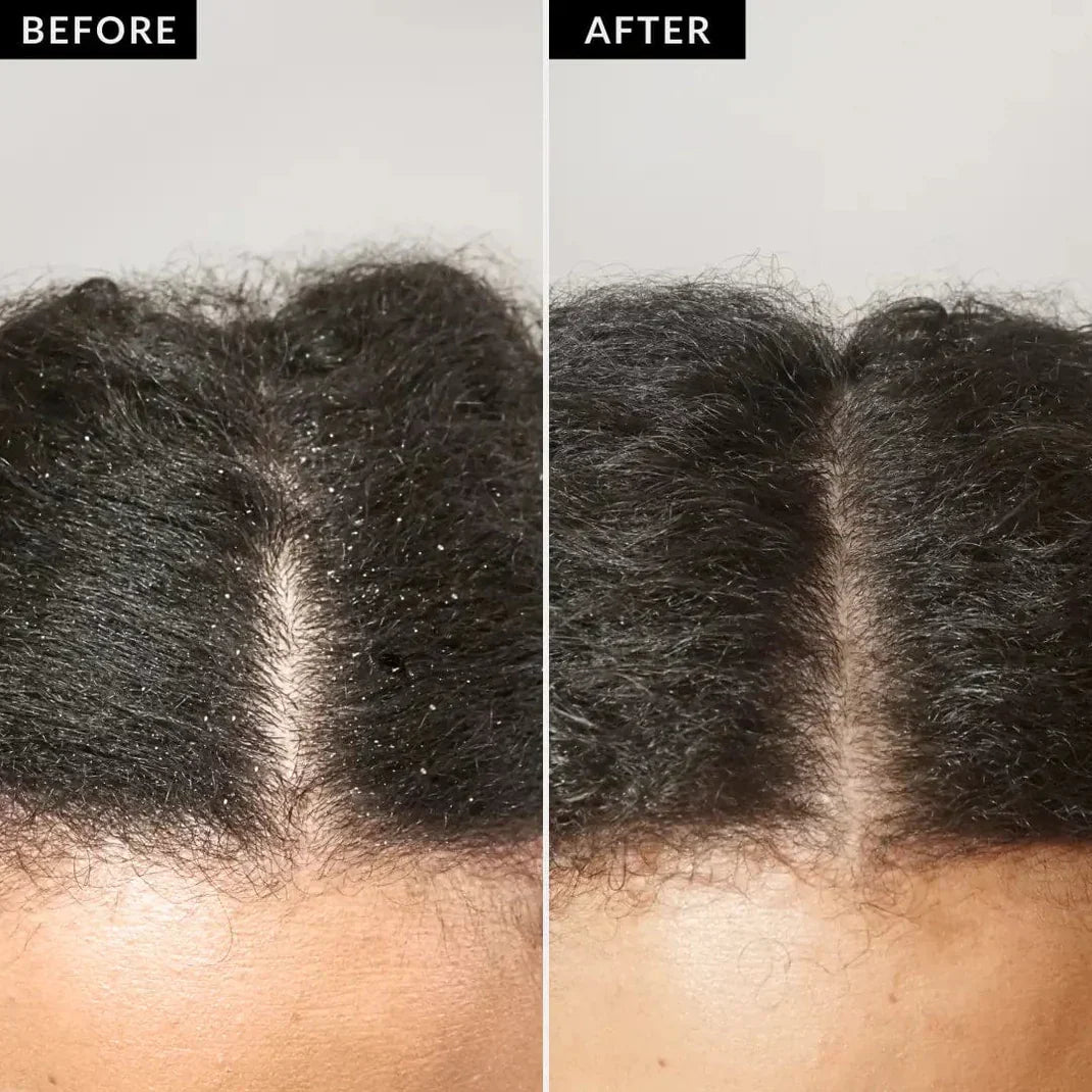 Scalpur™ - Scalp Detox Comb (30% Off) - Evesbury